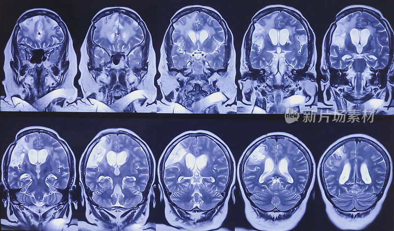 脑核磁共振成像和核磁共振成像。脑部显示脑软化伴广泛胶质增生及左额叶凸出病变。弥漫性T2WI FLAIR高强度。脑萎缩。